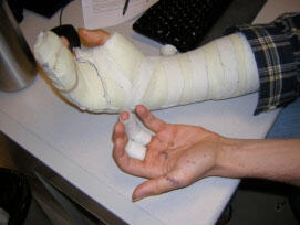 severely cut left hand, heavily bandaged right hand