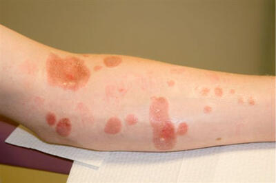 forearm with spotted chemical burns